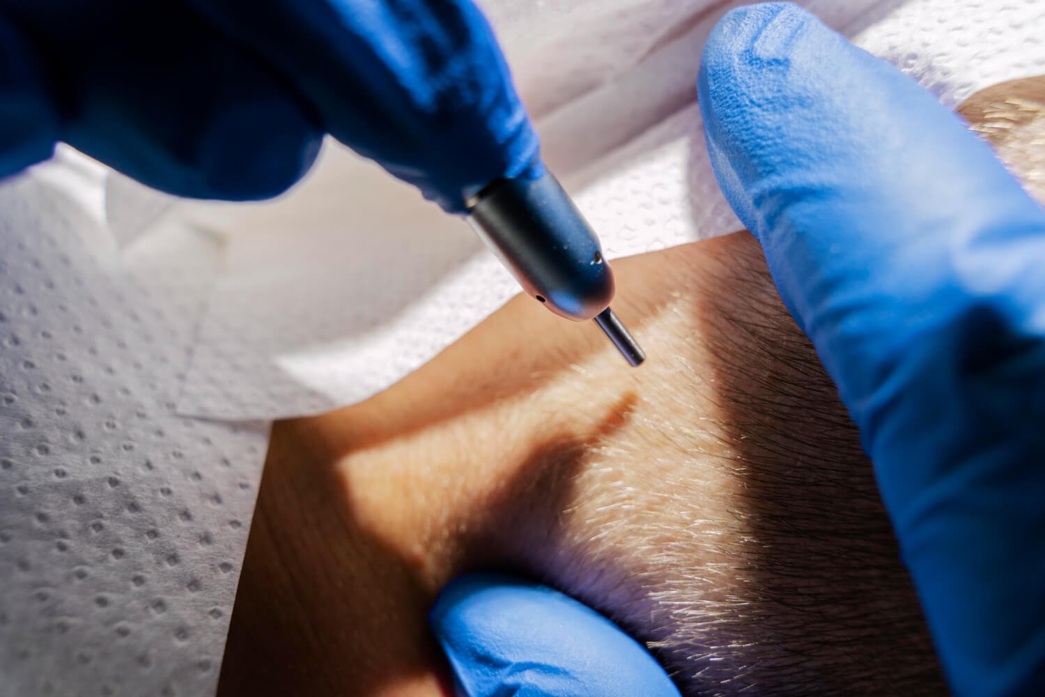 FUE vs Sapphire FUE in Dubai: Key Differences Explained